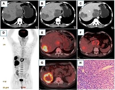 Inferring the diagnostic potential of 18F-FDG-PET/CT in post-renal transplantation from a unique case harboring multiple rare complications